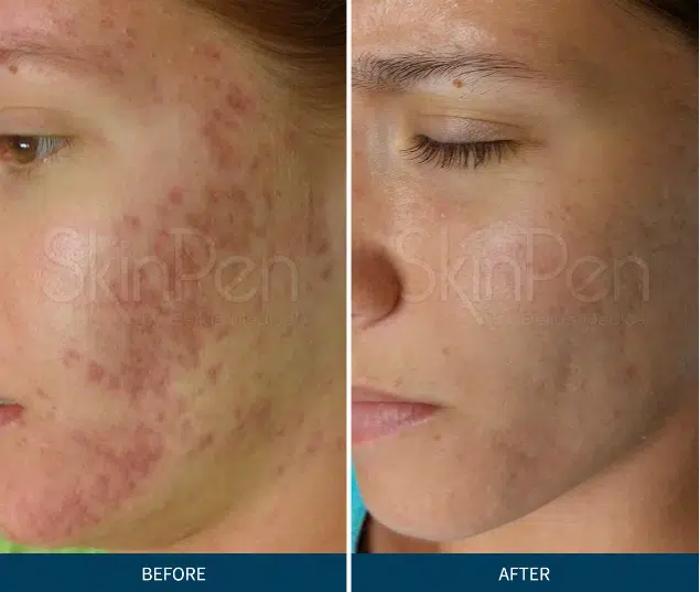Acne Treatment with Microneedling